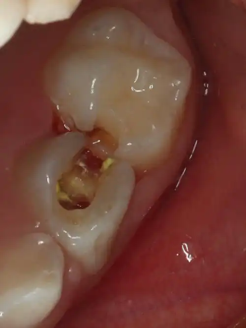 四岁小男孩主诉左上后牙疼痛,检查发现左上乳四邻