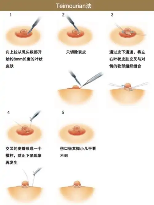 【乳头内陷怎么办?影响喂孩子吗?】