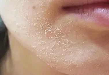 导致皮肤干燥的原因分析