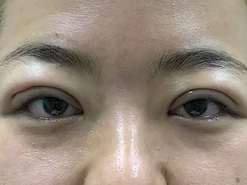 三点定位双眼皮,损伤小,恢复快!适合初眼,眼睛基础_圈子-新氧美容整形