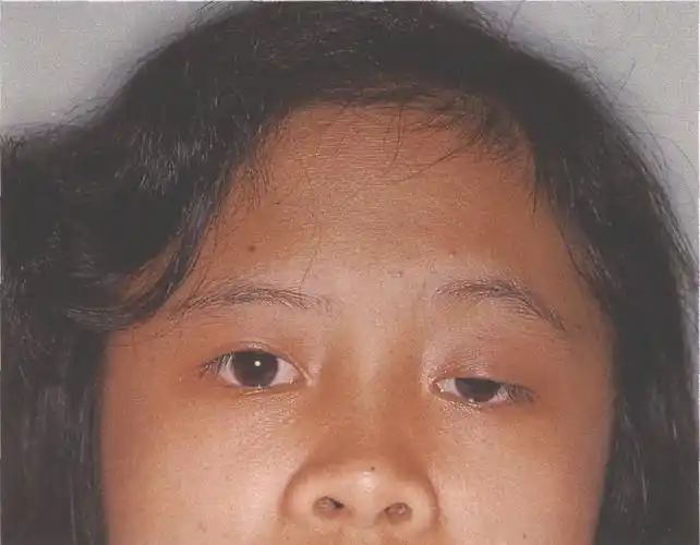 (图) 左侧先天性上睑下垂