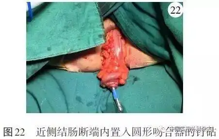 指南与共识直肠癌经肛全直肠系膜切除专家共识及手术操作指南2017版