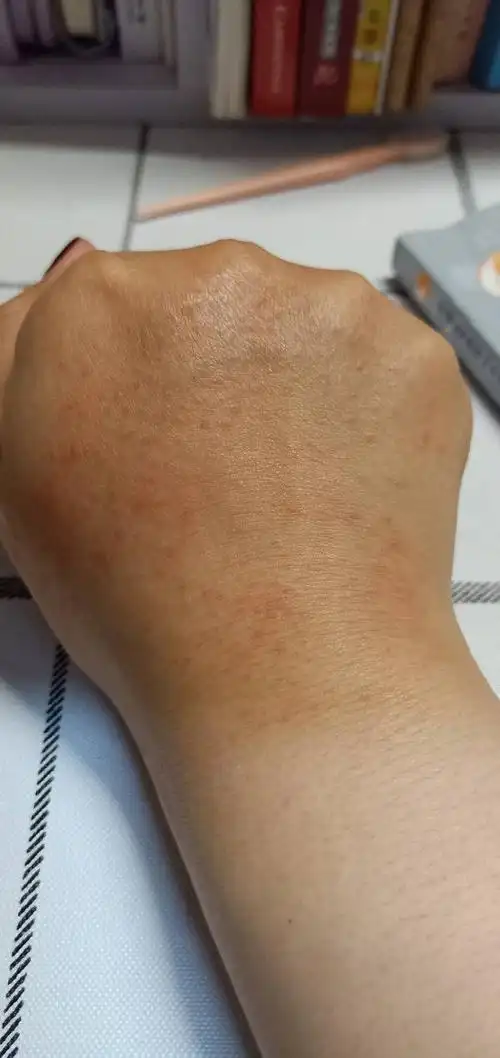 突然两个手背上起了很多的小红痘痘也不知道怎么回事