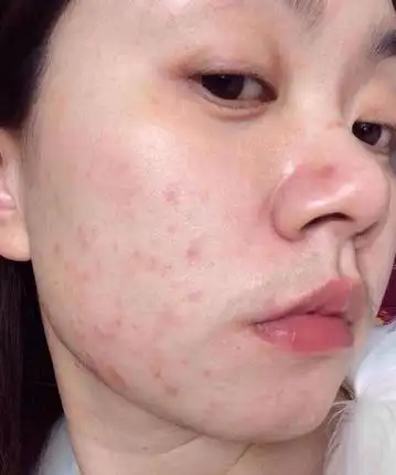 朵嘉浓玫玫;脸上用护肤品就过敏,是化妆品的问题吗?还是激素脸