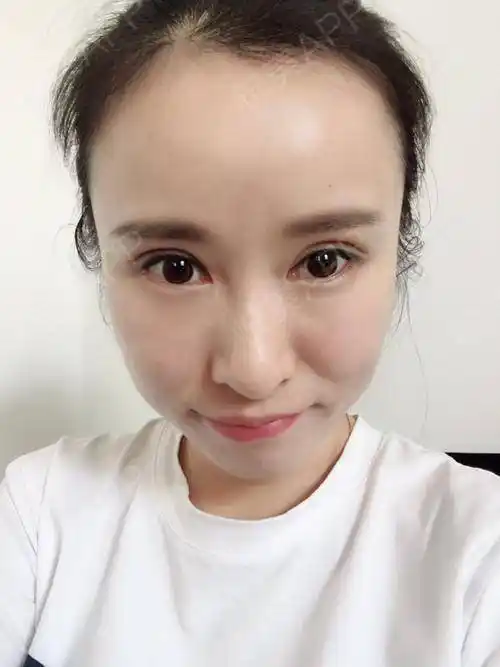 全切双眼皮术后7天_开眼角术后7天_双眼皮术后7天_眼部整形术后7天