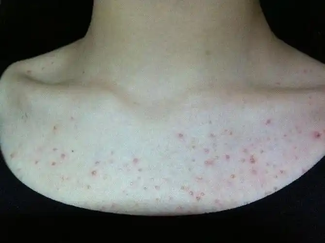 洗澡的时候用上海硫磺皂洗,用皮肤性病科 皮肤病