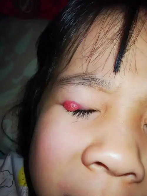 给宝宝做了霰粒肿手术