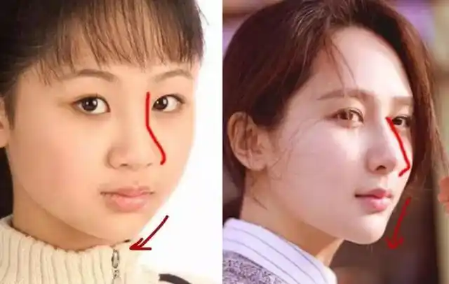 但是女明星在缩鼻翼的时候也要注意,千万小心,别像这位韩国女星任娜英