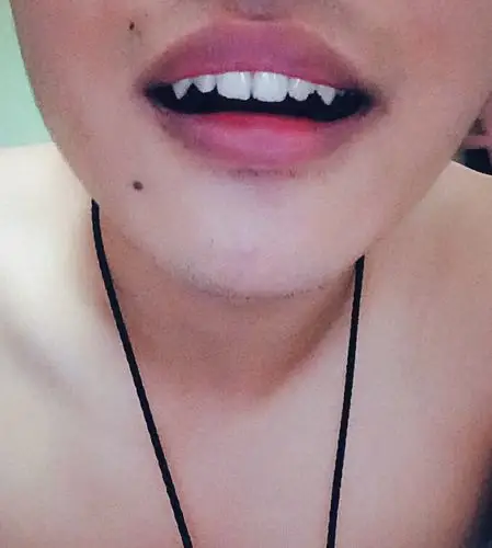 为什么我的牙齿很尖?是不是长歪了?我用不用矫正或者磨平?急