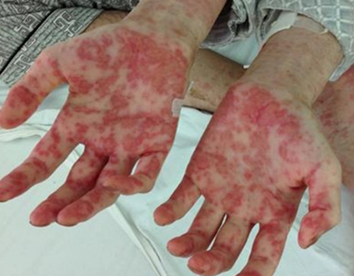 吃饺子的血癌女童感谢网友:为她募集10万元医疗费