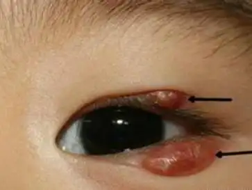 宝宝眼睑上长了这个"红包" ,可能会引发大危险