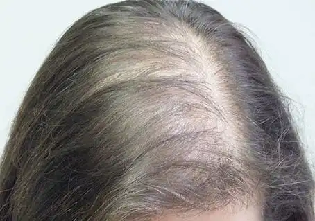 女性脂溢性脱发图片