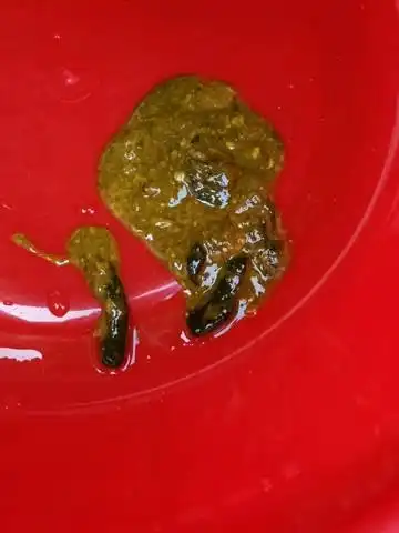 拉出来的大便这样的,是什么问题啊?