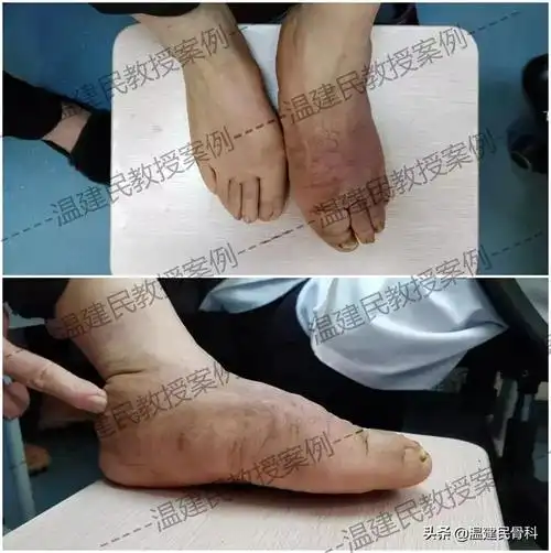 听说过"象皮腿"吗?