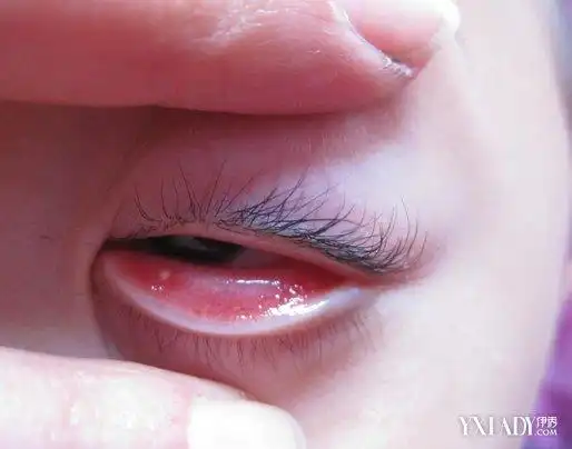 【图】眼睑内是哪里 盘点该部位的常见疾病及护理常识
