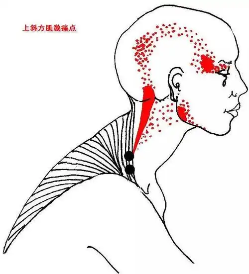 斜方肌的解剖与激痛点 - 好大夫在线