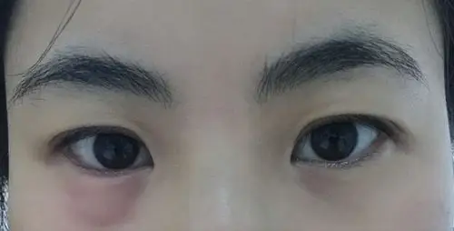 洗脸时突然发现下眼睑肿了一只,怎么回事?在线等,急