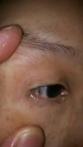眼皮上面有个白色的东西.像是胧包.不痒不痛.请问下是什么东西呢