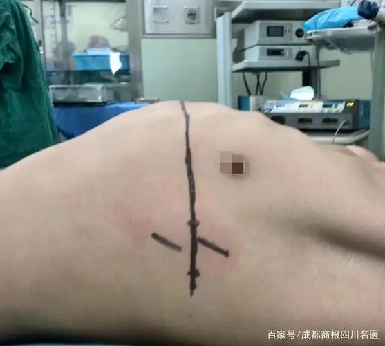 鸡胸 / 图片由医生提供