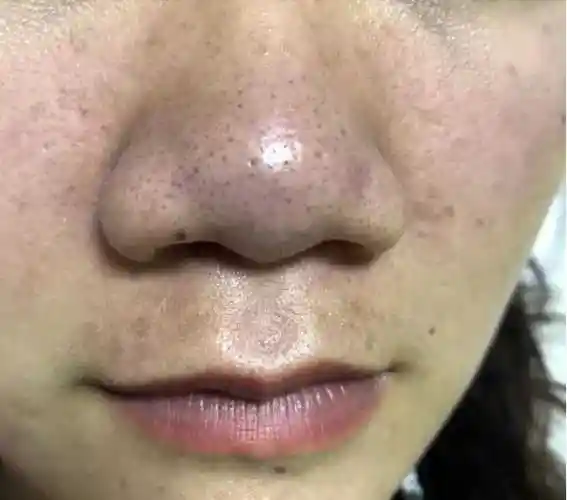 鼻子黑头好严重怎么办啊? - 知乎