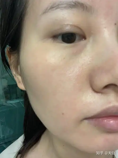 角质层受损真的是不治之症吗多久才能完全修复好呢