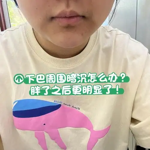 下巴周围明显暗沉怎么办?胖了之后更明显了