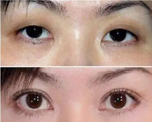 双眼皮前后对比