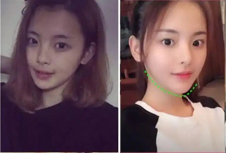 杨天宝的换头医生被杨超越找到了?整形前照片被公开,这锤太狠了