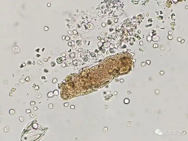 【多图对比】血液管型与血红蛋白管型鉴别|红细胞|镜检|沉渣_网易订阅