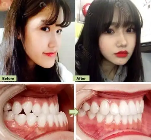长脸地包天做完牙齿矫正后前后对比效果
