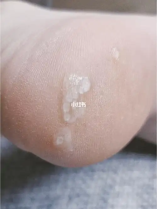 跖疣,鸡眼,老茧的克星,真的超级好用
