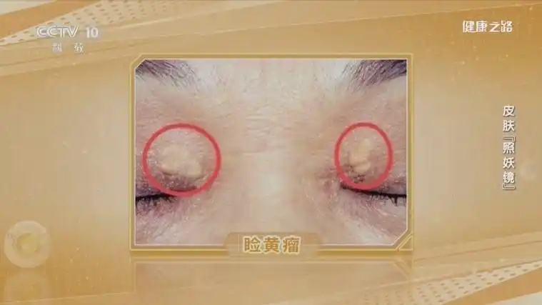[健康之路]皮肤"照妖镜" 内眼角出现黄色瘤状物与以下哪种疾病相关?