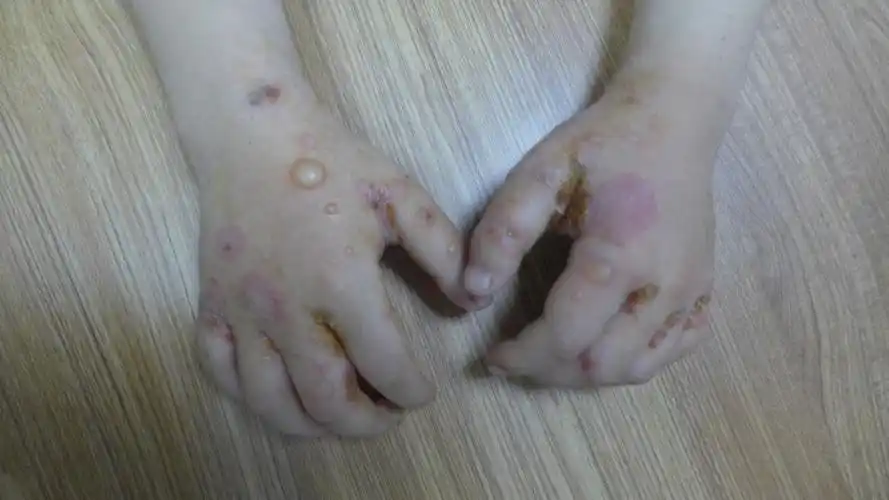 儿童疱疹样皮炎如何治疗