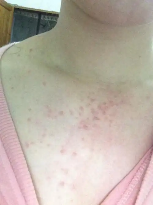 每年五月右前胸就会爆发痘痘