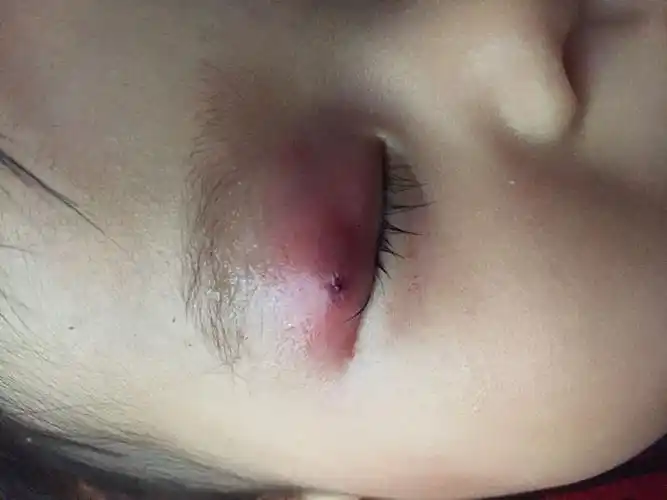 宝宝眼疖子破脓了妈妈可以吃鱼吗?