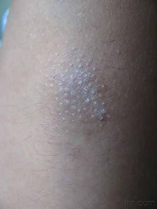 苔癣样皮疹 - 皮肤及性传播疾病讨论版 - 爱爱医医学论坛