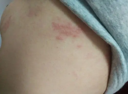 孕妇湿疹怀孕5个月身上先是痒过了端时间开始起水泡很疼一碰