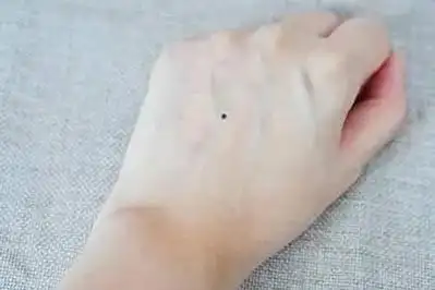 左手腕有两颗痣代表什么 哪里长痣前世姻缘未了