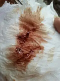 我怀孕一个半月,突然出现褐色血是怎麼回事