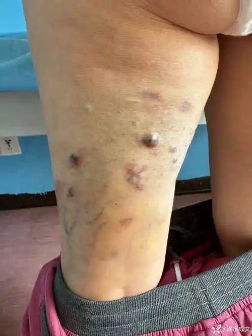 大腿血管瘤硬化剂治疗