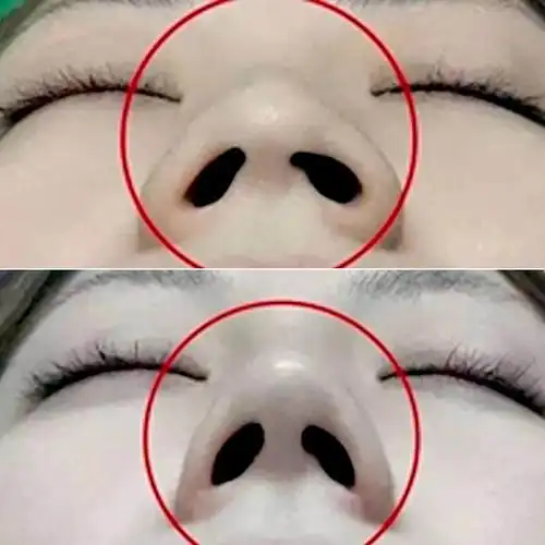 你高鼻梁鼻子增高男女鼻夹缩小鼻翼挺鼻器娇化妆