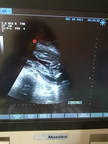 求大师,帮忙看看,男宝女宝?六个月图