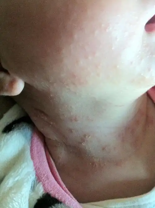 热疹湿疹分不清楚,如图所示,请医生鉴定,又该如何去治疗,万分感谢.