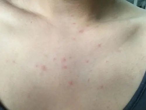 最近胸前长了好多白头小痘痘 都被我挤了 用什么药才能消痘印啊 (平常