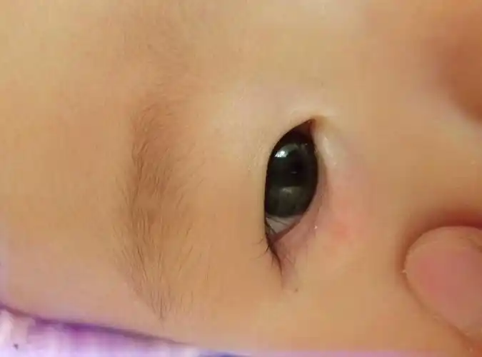 不知道宝宝下眼睑长的红色小痘痘是什么,几天了还没好,哭的时候眼睑