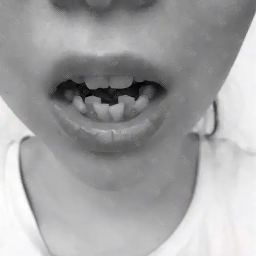 病,我是一个爱笑的女孩子,每次一笑,就能看到那一排东倒西歪的牙齿,吓