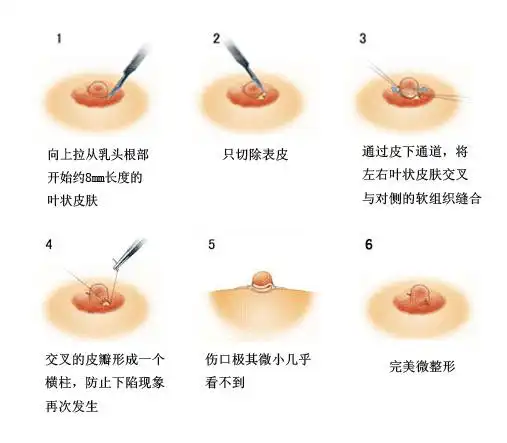 乳头内陷是怎么回事?与乳腺癌有关吗?_乳晕_炎症_治疗