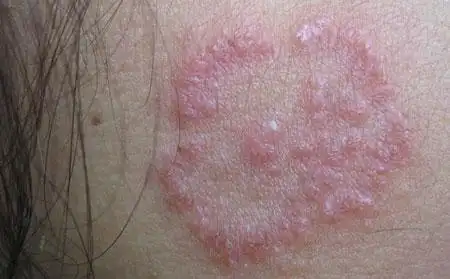 体癣初期症状的表现是什么呢?