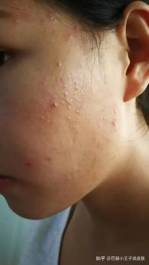 带你了解闭口的出生到消失教你如何把闭口扼杀在摇篮里