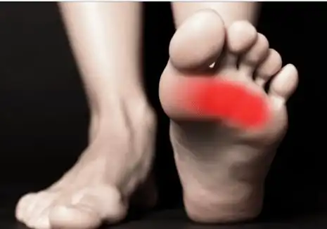运动康复前足底痛跖痛metatarsalgia